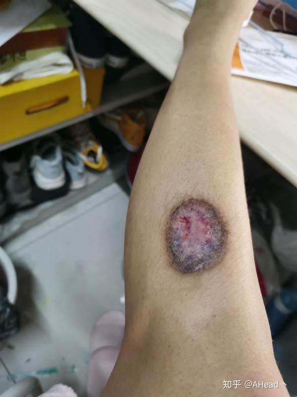 烫伤感染后抗疤痕治疗