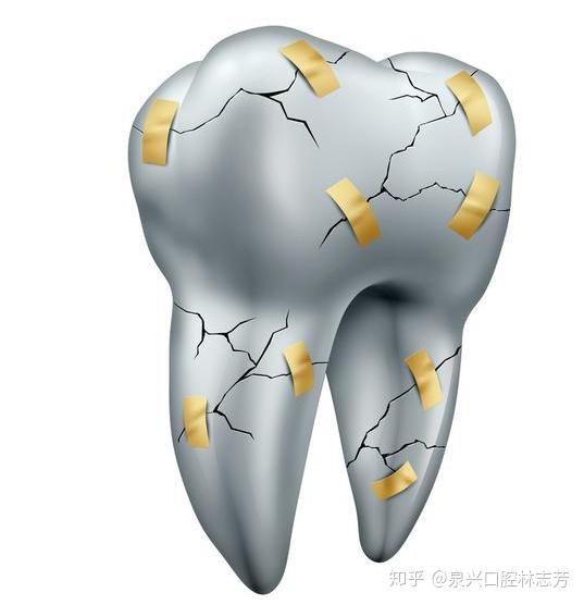 牙痛小心可能是牙隐裂