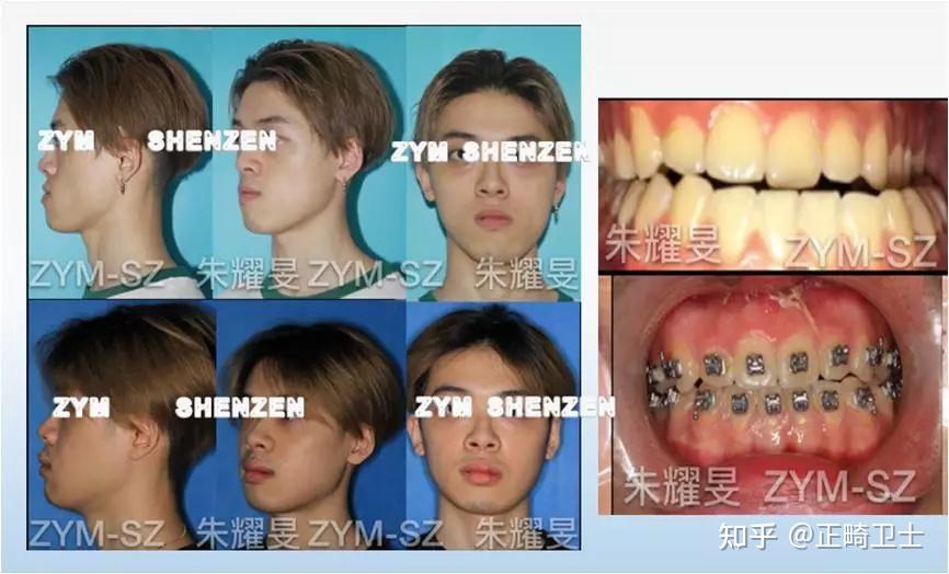 朱耀旻博士数字化正颌手术案例分享