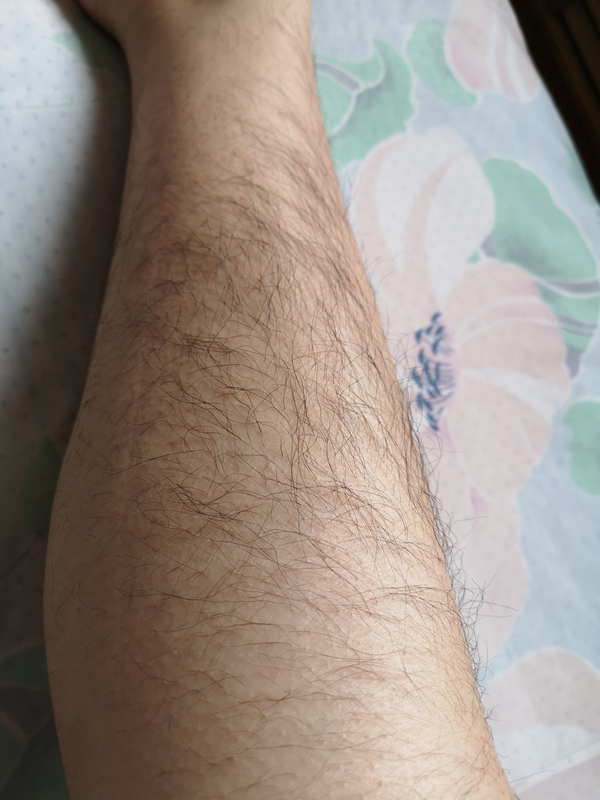 女生汗毛多怎么办?