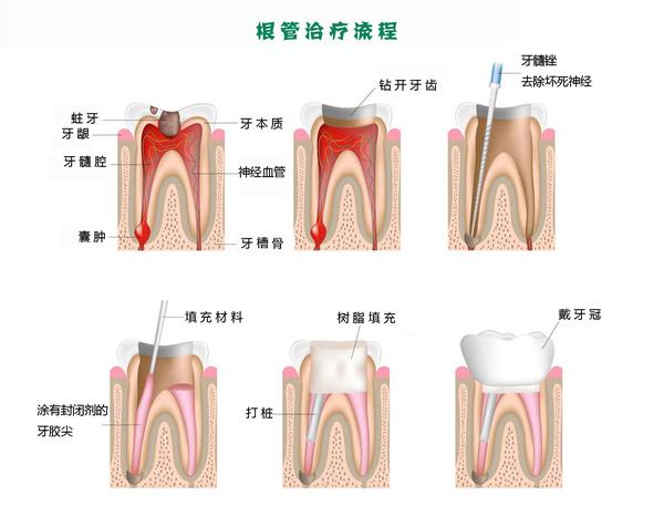 牙齿结构图和根管治疗流程