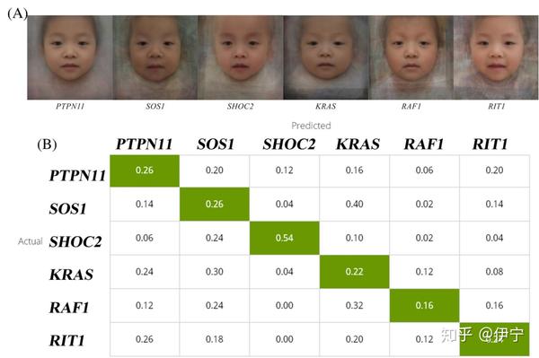 努南(noonan)综合征,一条通道里的一段故事