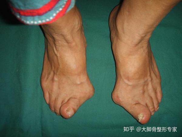 穿尖头鞋会加剧拇外翻,你知道为什么吗?