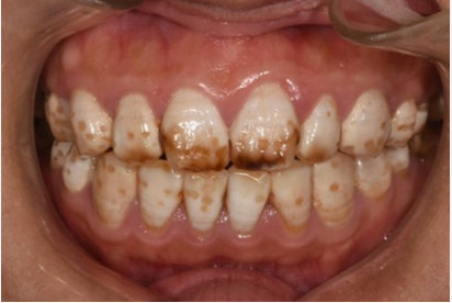 想要告别牙黄牙黑,改善异常形态的牙齿,从而拥有唇红