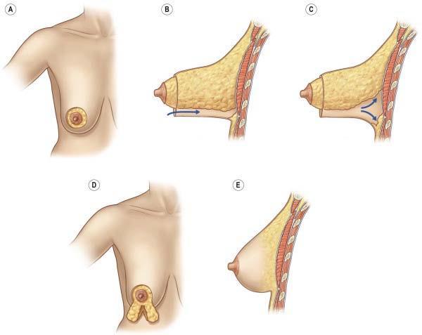 筒状乳房畸形(tuberous breast deformity)