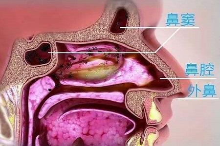 而鼻腔黏膜与鼻窦黏膜相连,常出现黏膜充血,肿胀,导致鼻窦口引流不畅