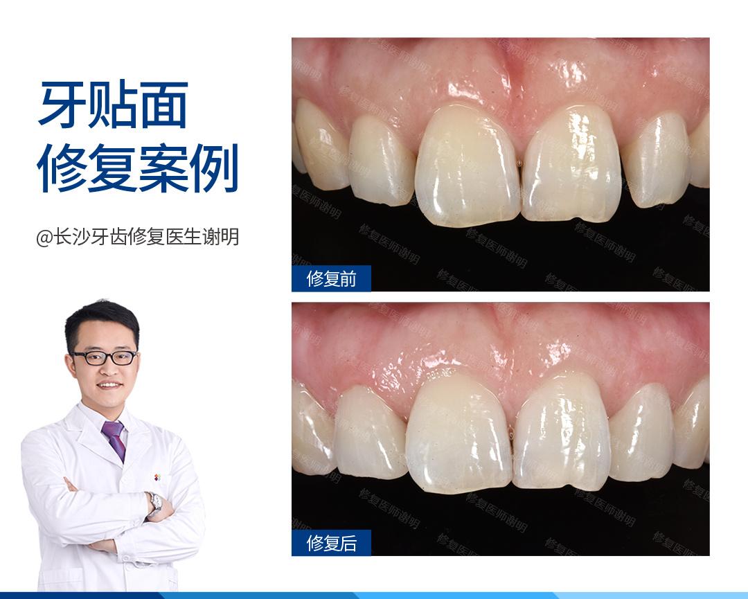 长沙牙医案例:牙齿门牙缝隙,如何做到不磨牙修复?