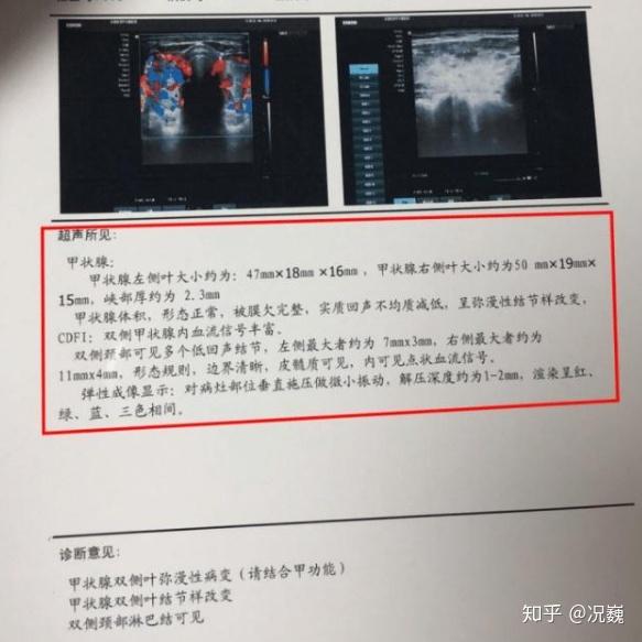 甲状腺彩超彩超诊断图