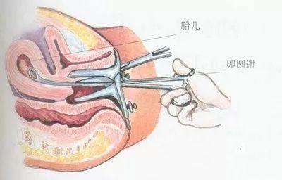 这个行为能诱发子宫腺肌症女人最好不要尝试