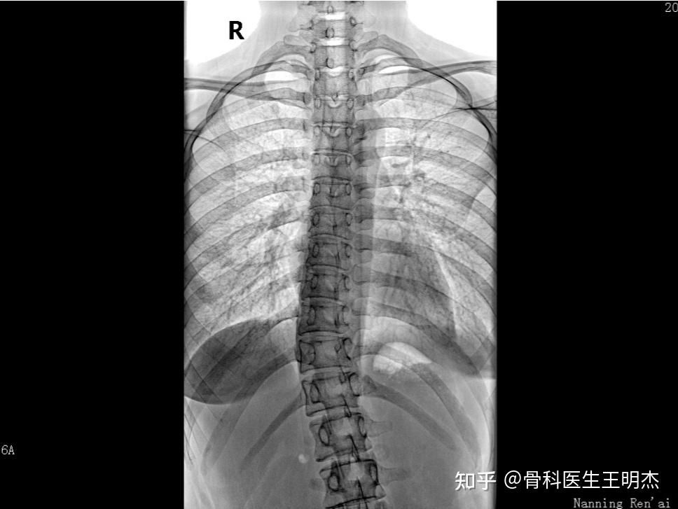 脊柱侧弯术后变成截瘫有多少人后悔了