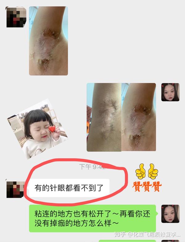 腋下严重疤痕,中药代谢一次,针眼消失了