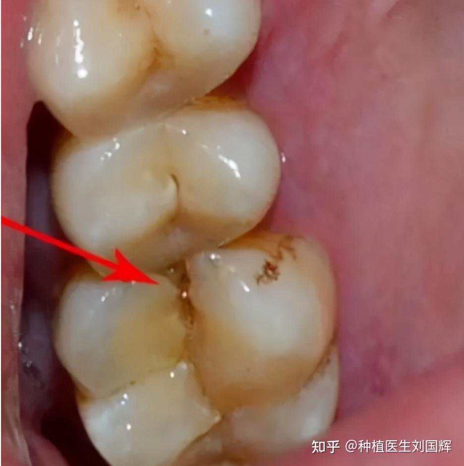 急性牙髓炎的主要感染源是来自深髓,牙髓的感染可通过根尖孔引起根尖