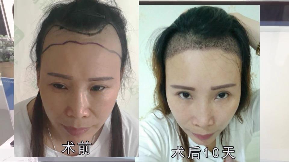 脱发的人,你为什么要去植发,植发的理由是什么?