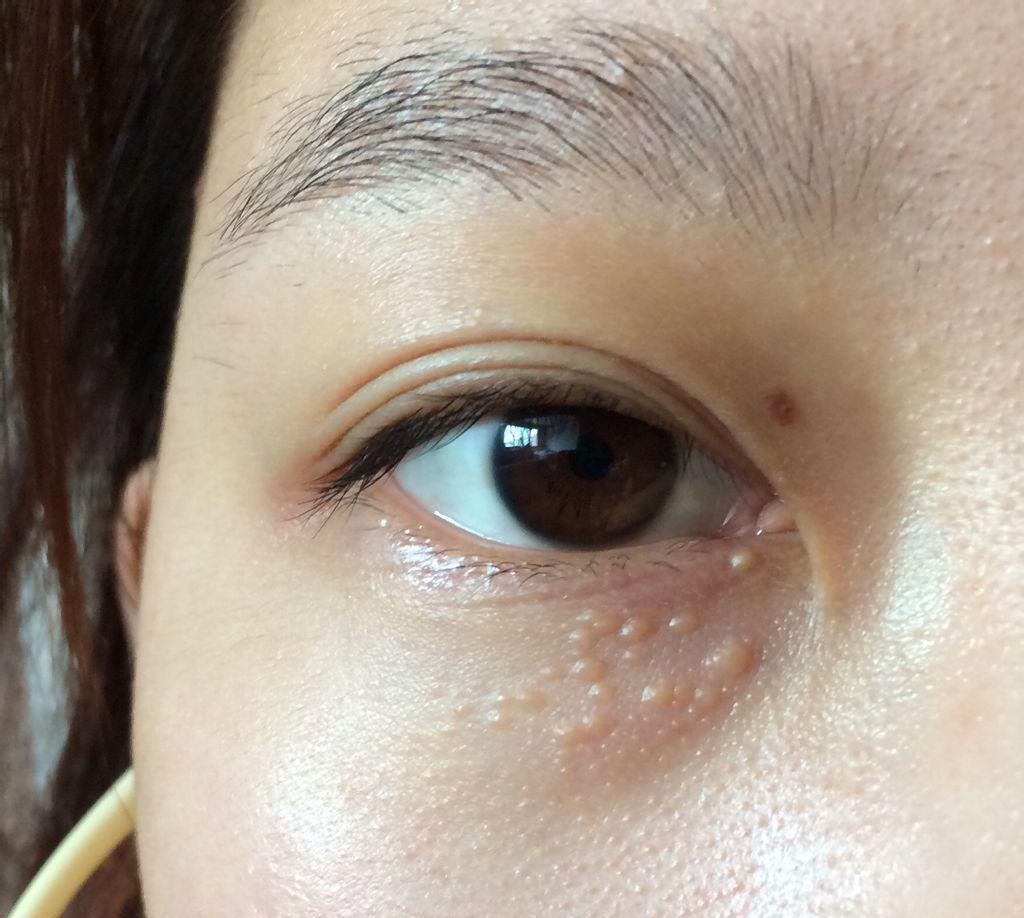 眼皮上长了脂肪粒怎么办