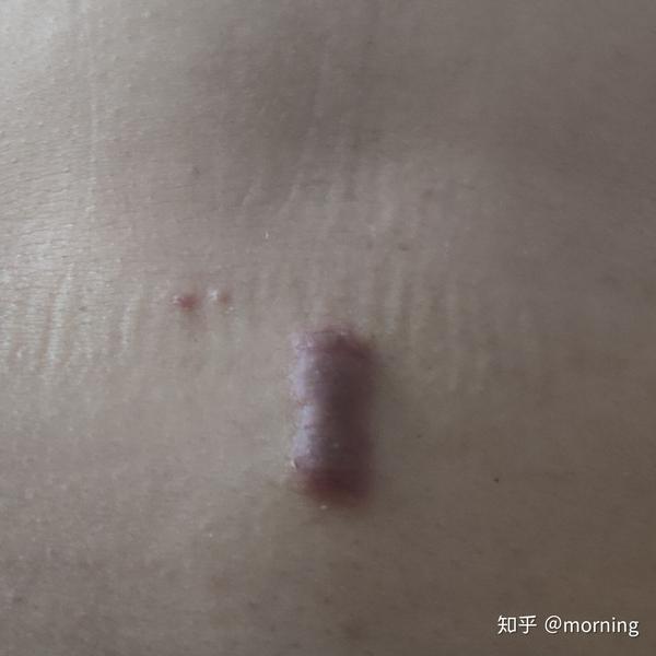 我与瘢痕疙瘩的一些事