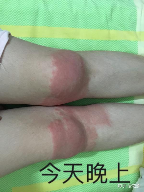 人生路难就长——贴膏药过敏