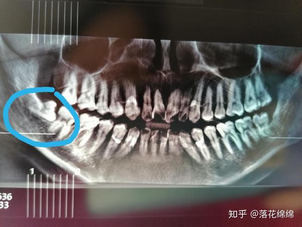 之前长第一颗智齿是上颚的,通过熟人介绍去一家私人口腔诊所拔掉了