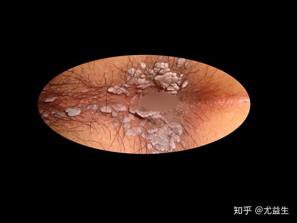 尖锐湿疣是一种病毒感染引起的皮肤性病,它是由人类乳头瘤病毒