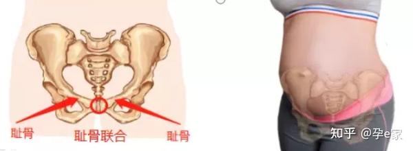 耻骨痛是耻骨联合分离造成的.