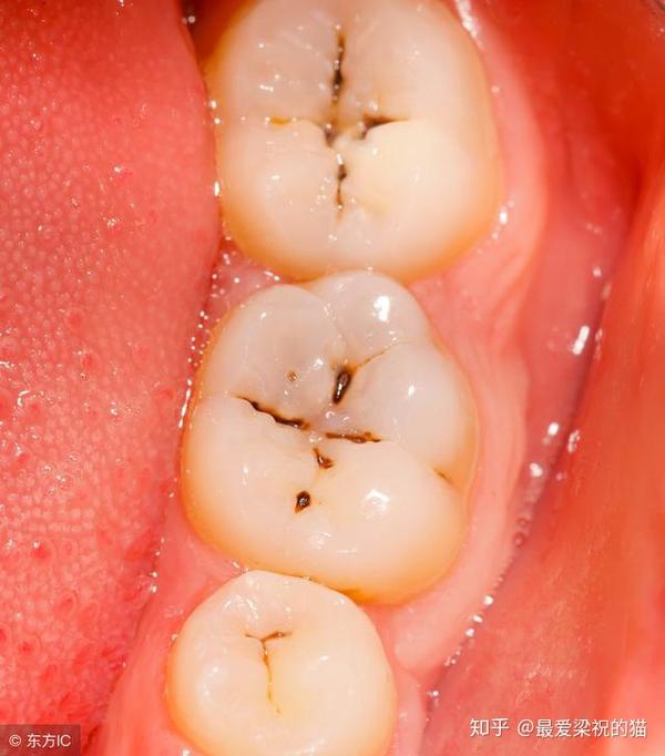 食物残渣堆积在牙齿内部,刺激牙龈,导致牙龈乳头炎症性退缩,慢慢地