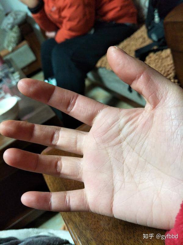 年纪轻轻23岁手上皮肤就很干有很多皱纹,像老年人干瘪的手,怎么办呀?