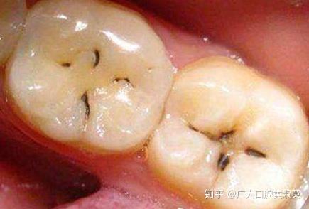 1)牙齿表面形成黑线,初步形成蛀牙,这个阶段是蛀牙早期.