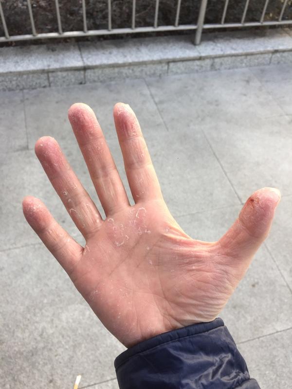 季节性手脱皮什么原因有什么方法可以根治吗