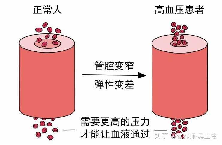 各种可能造成血液循环障碍的因素都可能导致血压升高,如:血脂高/血管