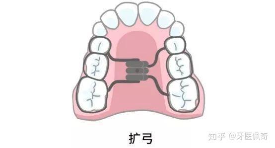 牙齿扩弓到底是什么 知乎