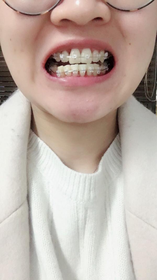 女生矫正牙齿后变美是怎样的体验