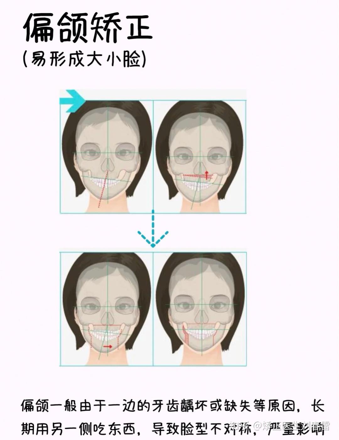 地包天-易形成"月牙脸以下三类人牙步矫正,脸型变化最大矫正.