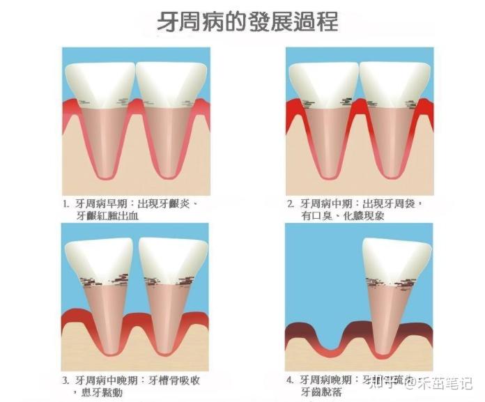 怎么判断牙周炎