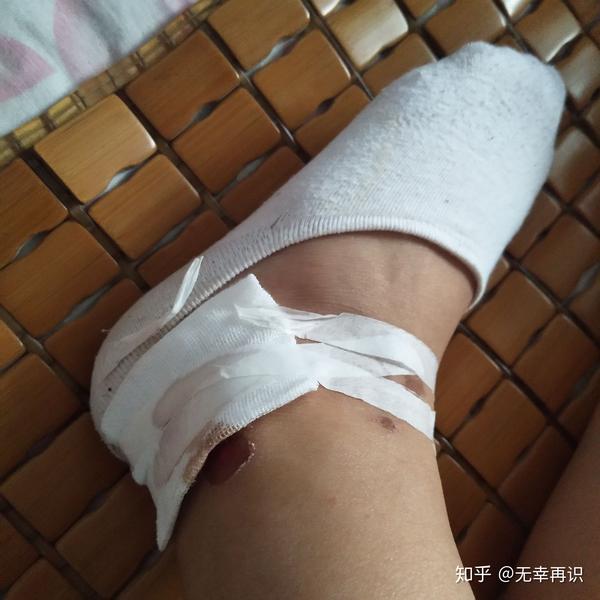 我是昨天自己骑车摔下来的,脸上,手上,脚上,胳膊上能摔得地方都摔到了