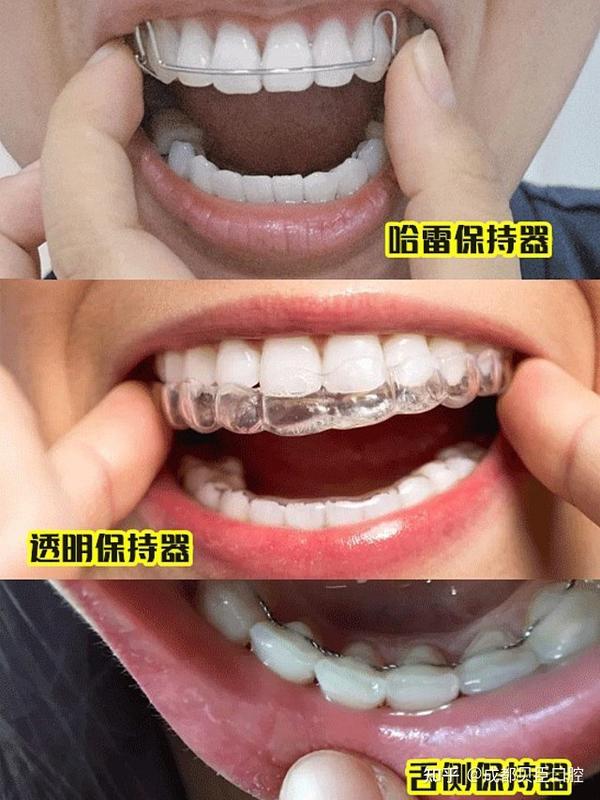 泸州牙齿矫正摘牙套后保持器需要戴多久