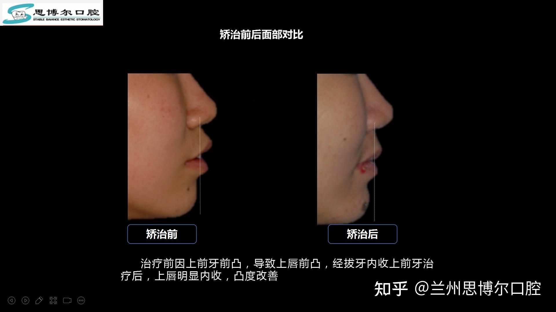 重度深覆盖龅牙伴上牙上唇前突的拔牙矫治案例