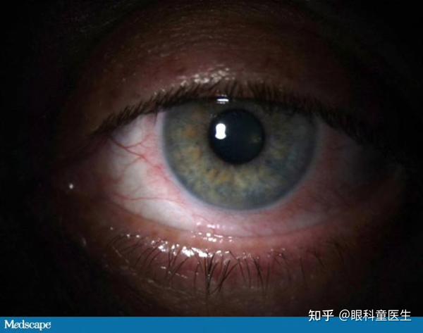青光眼睫状体炎综合征