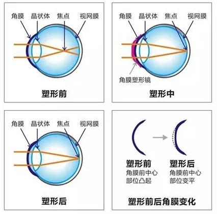 哪些眼镜有防控近视的作用?