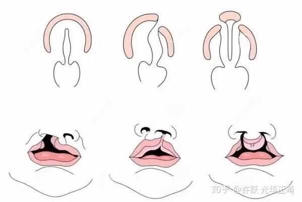 不同类型的唇腭裂