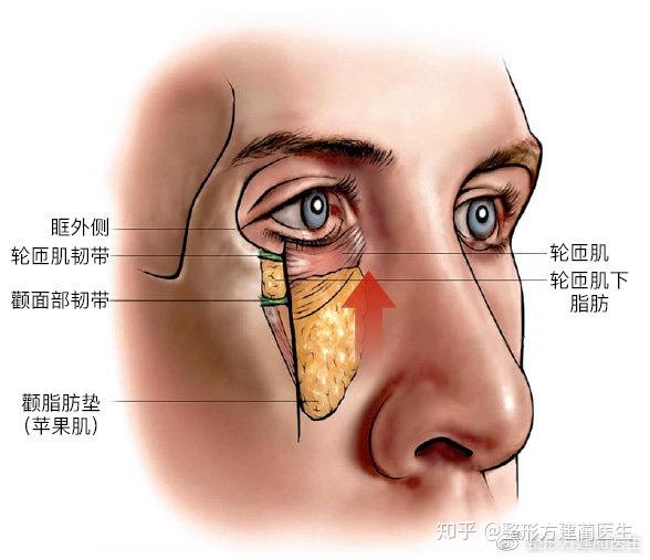 同时兼顾解决面中部松弛眼袋泪沟三重问题睑缘切口面中部提升术真的