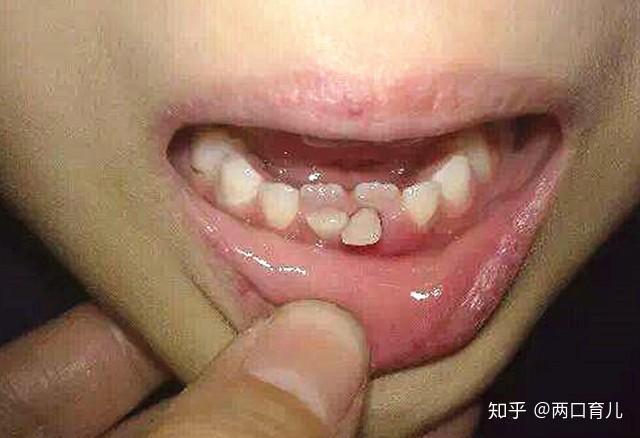 孩子出现双排牙需不需要将乳牙拔掉医生提醒要视情况而定
