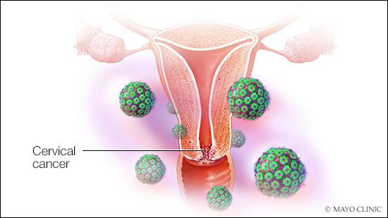 hpv病毒人类乳头瘤病毒和宫颈癌疫苗