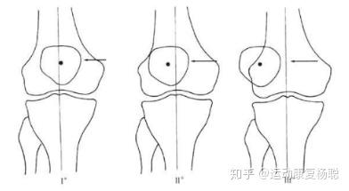 膝盖痛,膝关节髌骨半脱位运动康复来了