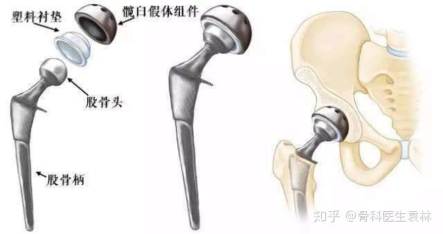 人工髋关节什么样子的人工髋关节的使用寿命有多长