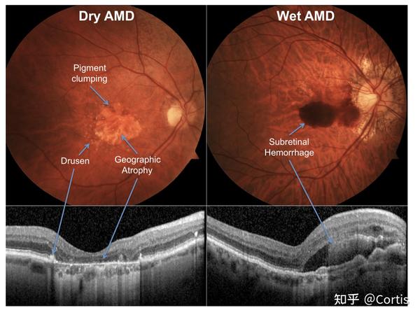 年龄相关性黄斑变性(amd): 干性amd(萎缩性或非渗出性)