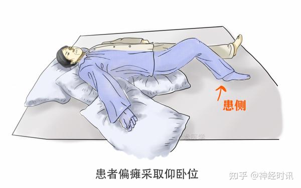 健侧卧位 1,头部:头部枕在枕头上,躯干正面与床面保持直角 2,上肢