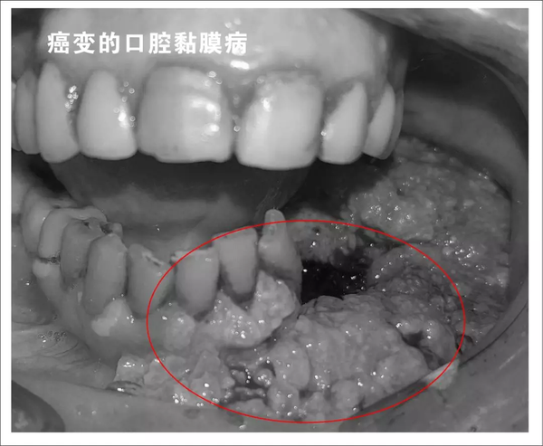 一旦出现口腔粘膜下纤维化,早期患者会感觉自己口腔灼烧感,还会出现