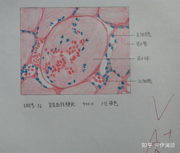 浆细胞:卵圆形,胞浆蓝紫色(红蓝都涂),核呈车辐状,偏向一侧,核周有空