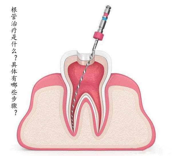 根管治疗是什么?具体有哪些步骤?