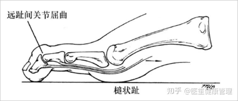 槌状趾如下图所示,跖趾关节与近趾间关节处于中立的位置,远趾