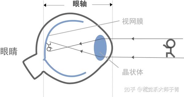 眼轴增长了就是度数加深了吗